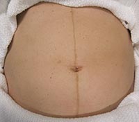 Linea nigra durante el embarazo