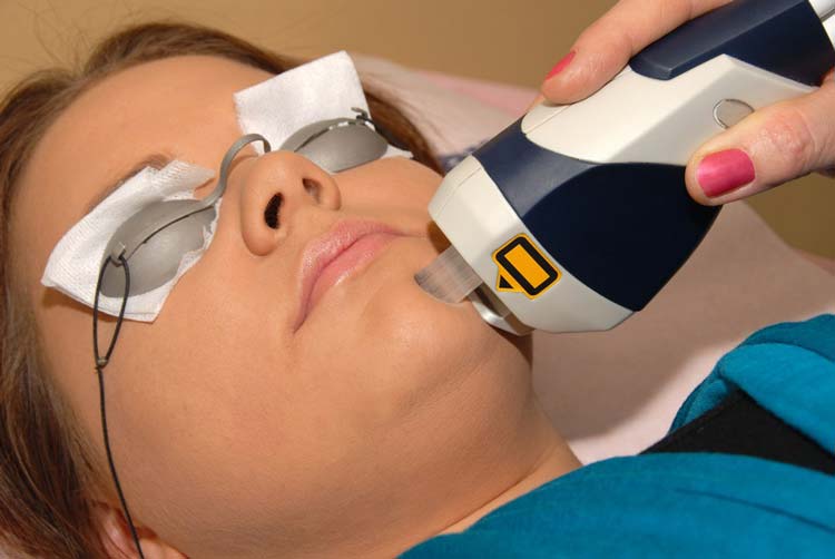 Protectores oculares para la depilación láser facial